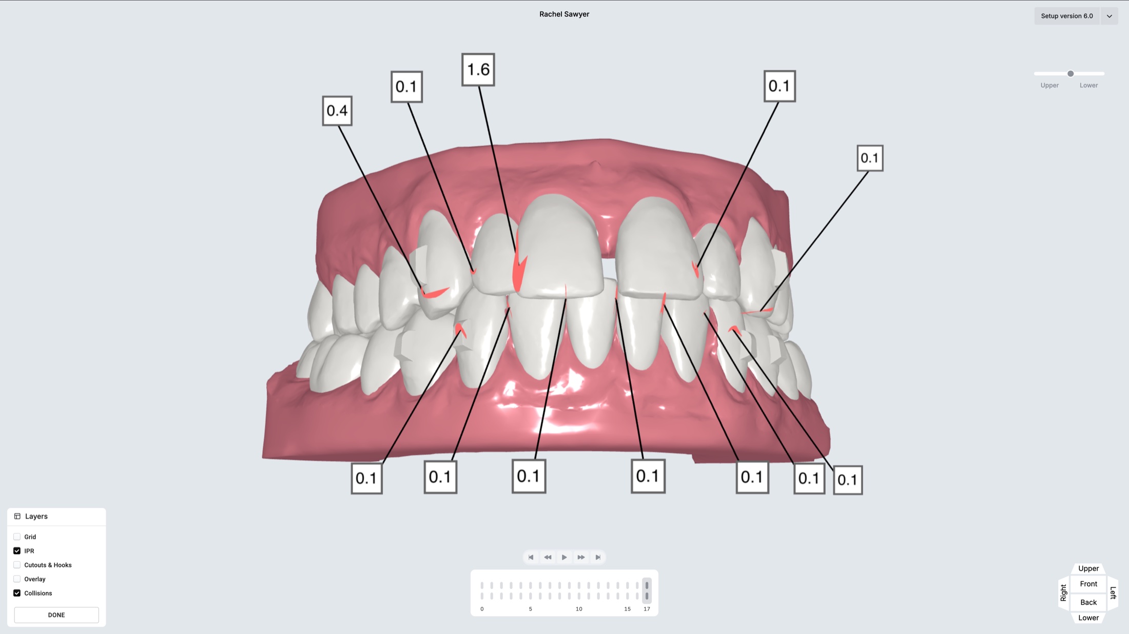 3D WebGL dental model for Rachel Sawyer showing IPR measurements, upper and lower arch view, with layer controls and staging timeline